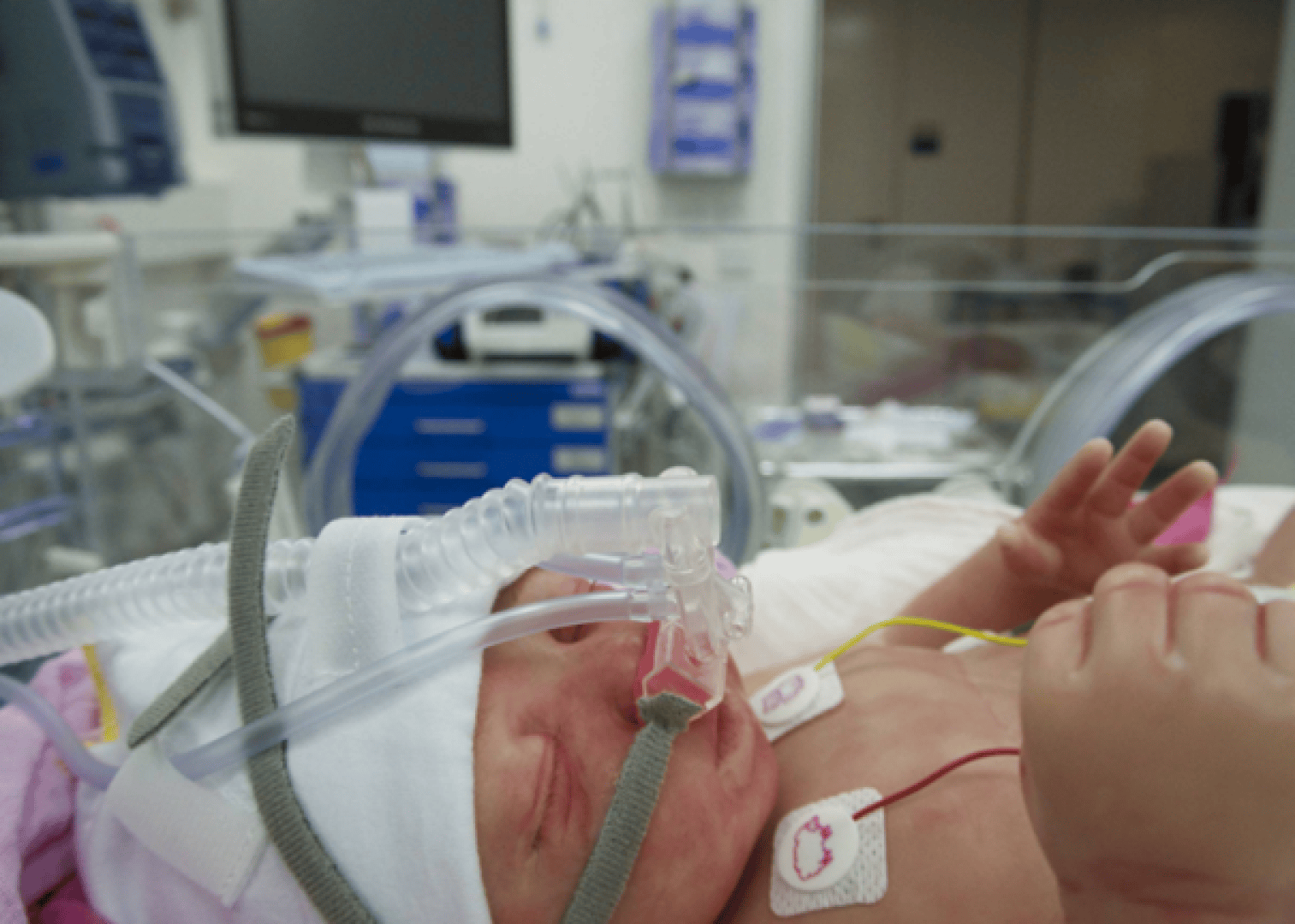 Ein Neugeborenes liegt in einem Inkubator mit Atemmaske und Überwachungskabeln auf der Neugeborenen-Intensivstation (NICU) eines Krankenhauses. Im Hintergrund sind medizinische Geräte zu sehen.
